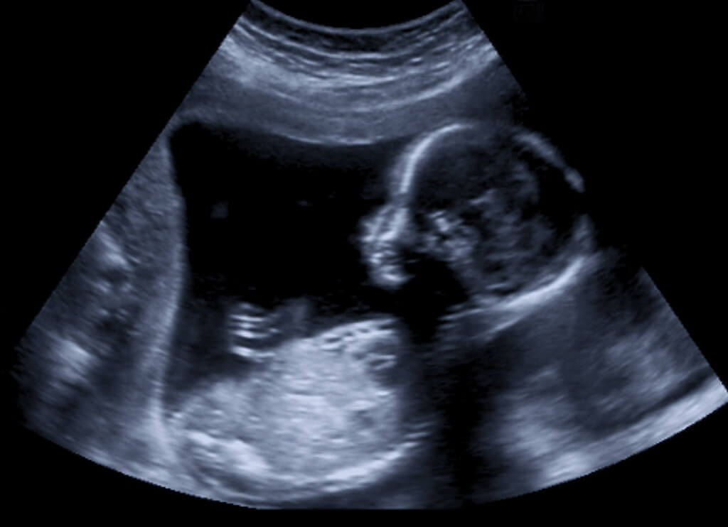 baby ultrasound for research at Cerebra into brain conditions.