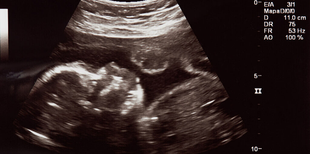 Baby scan for University of Barcelona research.